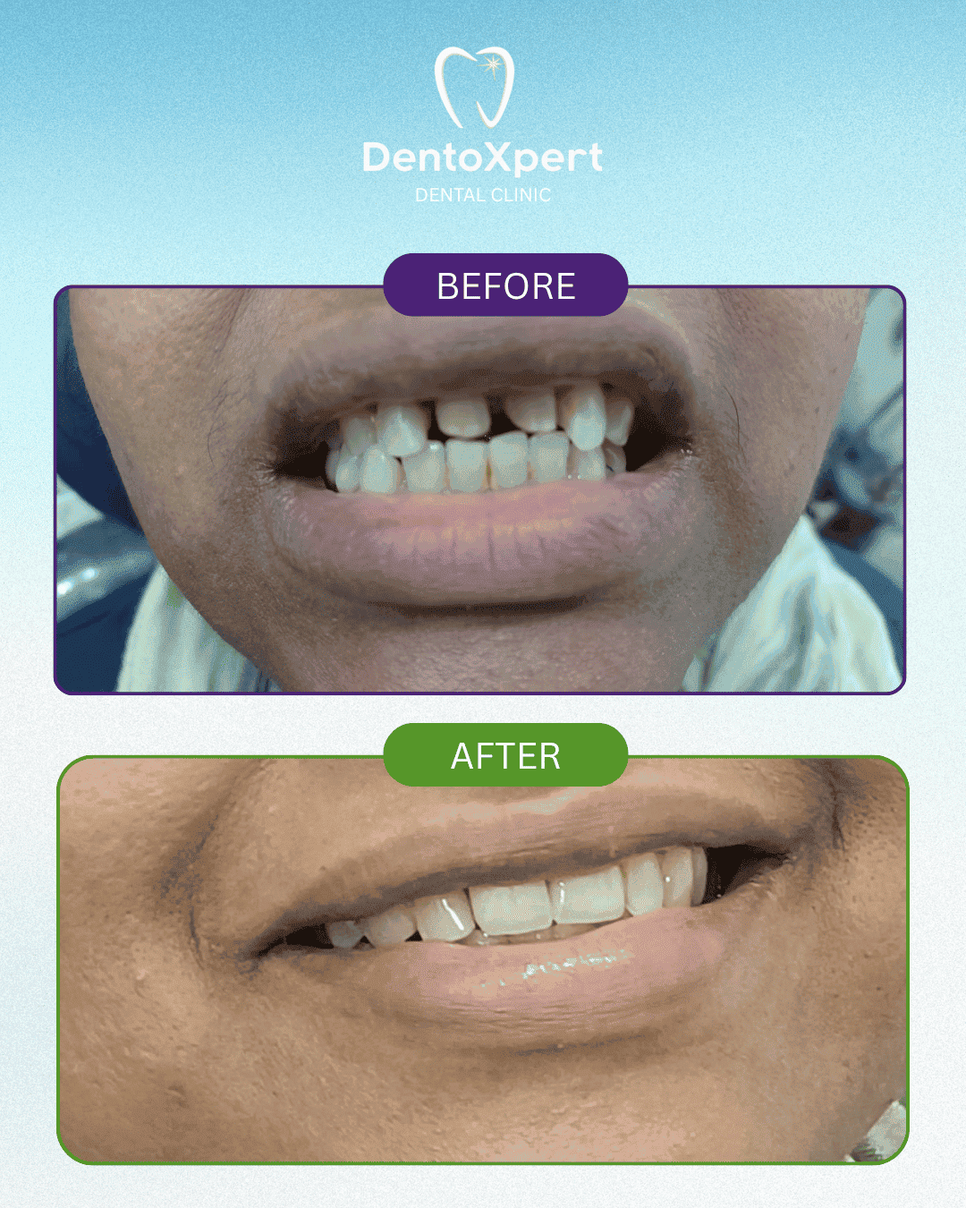 Before and after dental treatment result at DentoXpert Dental Clinic in Thane